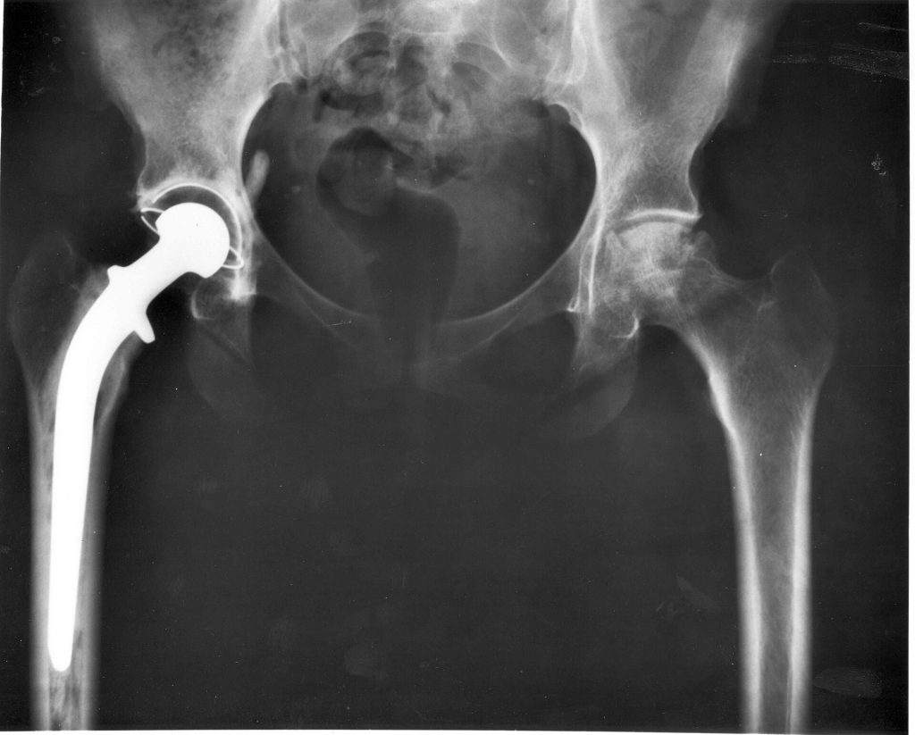 An A-P X-ray of a pelvis showing a total hip joint replacement. The right hip joint (on the left in the photograph) has been replaced. A metal prostheses is cemented in the top of the right femur and the head of the femur has been replaced by the rounded head of the prosthesis. A white plastic cup is cemented into the acetabulum to complete the two surfaces of the artificial "ball and socket" joint. Although not the case here, hip prostheses can also be made of a ceramic material which rarely wears out during the patient's lifetime. During the operation, a bonding cement is used to fix the metal prostheses into the shaft of the femur and the plastic cup to the acetabulum (socket in the hip bone). One of the leading reasons for hip replacement is osteoarthritis of the hip joint in which virtually all of the cartilage around the top of the femur bone deteriorates due to wear over time, leaving a grinding bone-on-bone situation with the bone surfaces becoming roughened leading to pain and stiffness. Narrowing of joint space (the space between the acetabulum and the head of the femur) is also a feature of osteoarthritis. There may be other changes which are not entirely clear on this A-P X-ray, which probably should be reported together with lateral X-rays of the hips, or with modern computerised imaging techniques. Keywords: total hip replacement, prosthesis, osteoarthritis, X-ray.